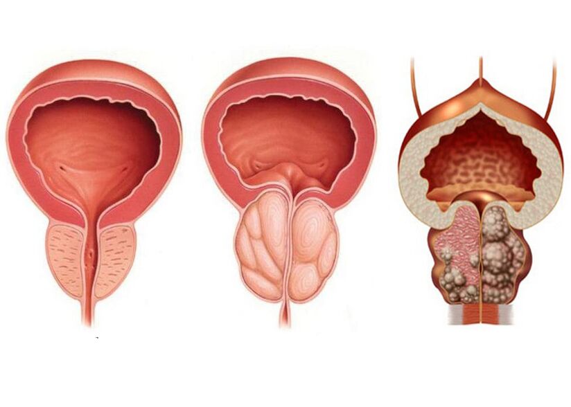 Etappe vun der Prostatitis an de Besoin fir Behandlung mat Prostavit