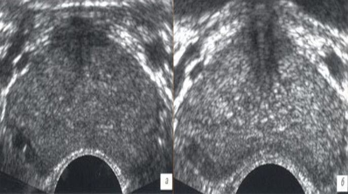 Ultraschall virun an no der Behandlung mat Prostovit Drëpsen