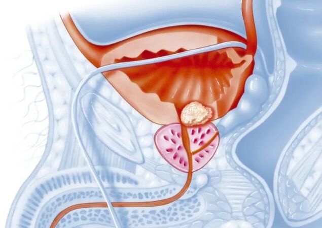 Features vun der chronescher Form vu Prostatitis
