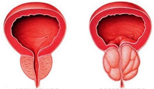 Chronesch Prostatitis