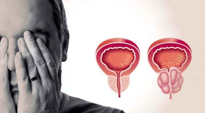 prostatitis