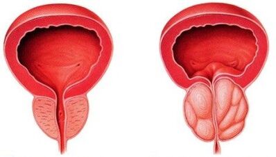 Gesond an entzündegt Prostates mat Prostatitis